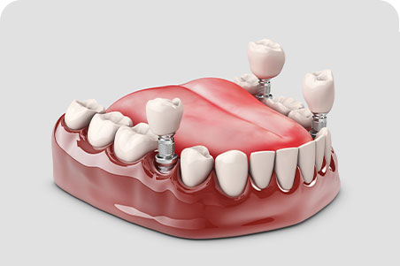 DH Dental Prosthodontics | Dental Implants, Dentures and Full Mouth Reconstruction